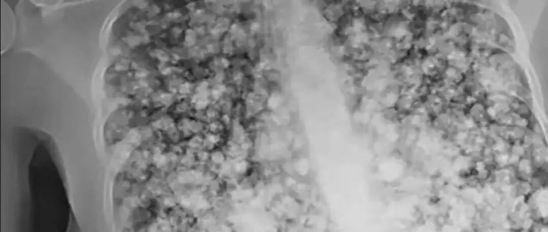 17岁少年肺被炸成爆米花，这个罪魁祸首你家也许有！