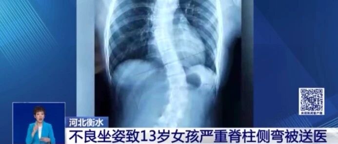 吓人！中小学生脊柱侧弯人数已超500万！这些不良习惯让娃速改！