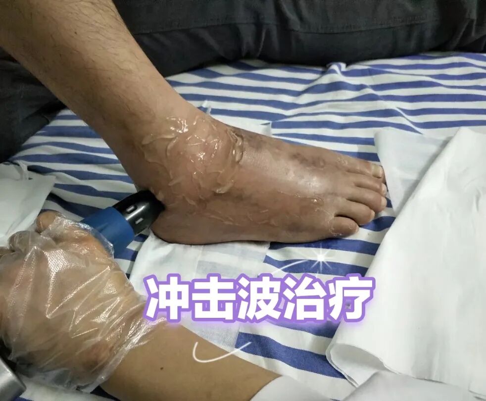 中频为什么能镇痛筋伤科：中频电治疗仪在踝关节扭伤的应用_https://www.jmylbn.com_新闻资讯_第7张