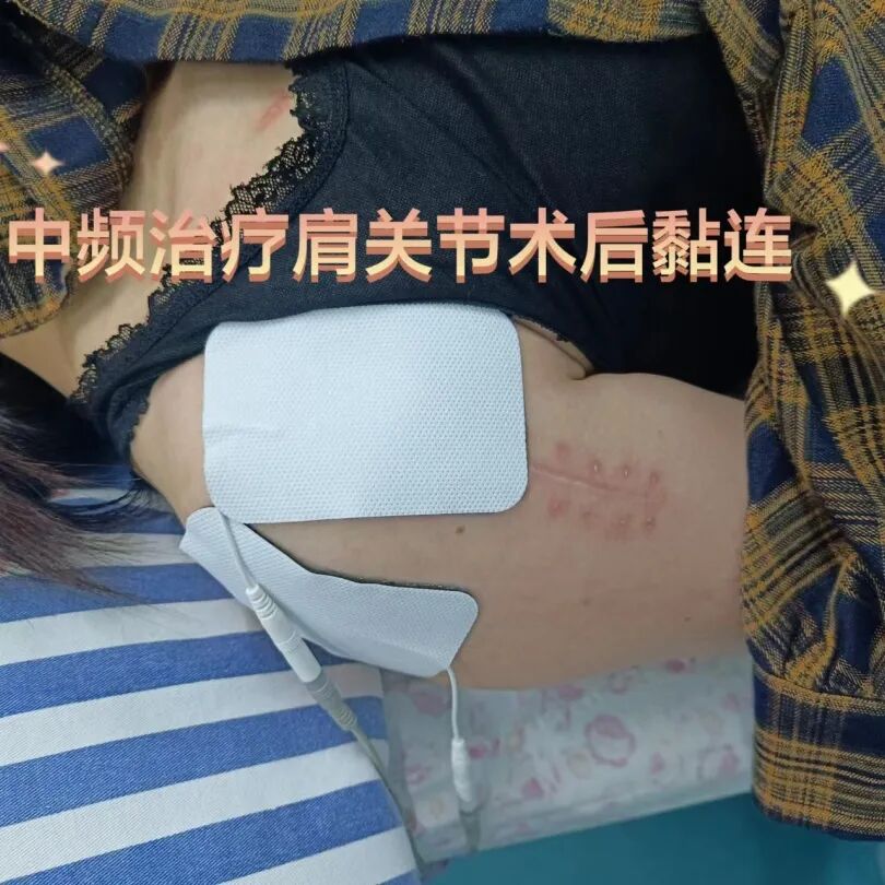 中频为什么能镇痛筋伤科：中频电治疗仪在踝关节扭伤的应用_https://www.jmylbn.com_新闻资讯_第14张