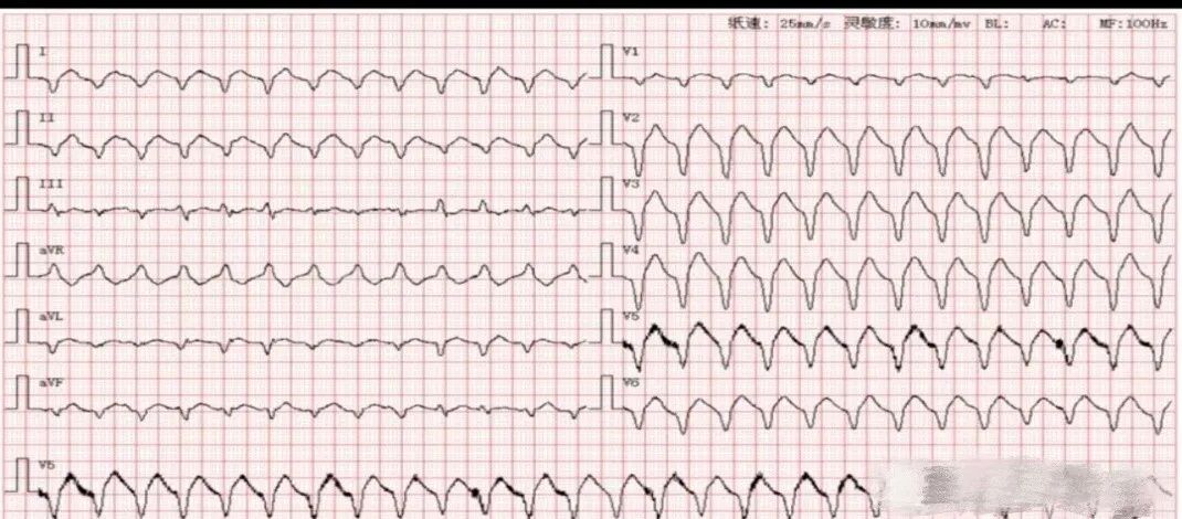 全麻后为什么送icu为什么全麻手术后患者要在ICU监护——从死神手里抢回来的病人告诉你答案_https://www.jmylbn.com_新闻资讯_第2张
