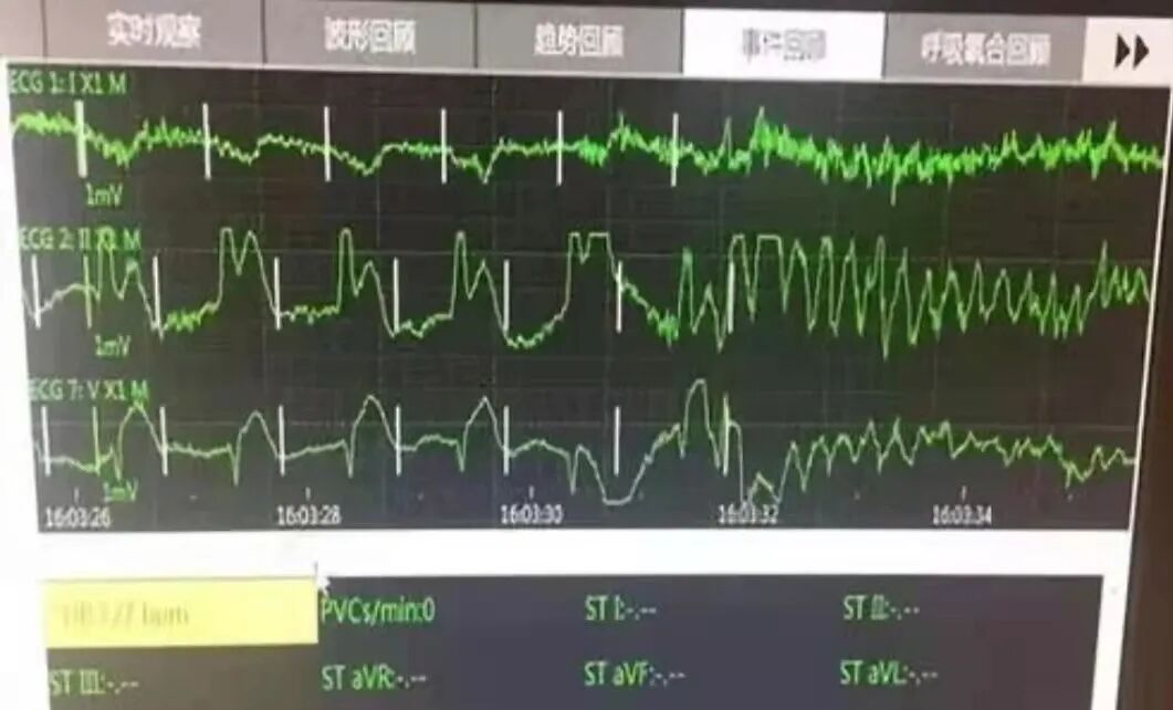 全麻后为什么送icu为什么全麻手术后患者要在ICU监护——从死神手里抢回来的病人告诉你答案_https://www.jmylbn.com_新闻资讯_第1张
