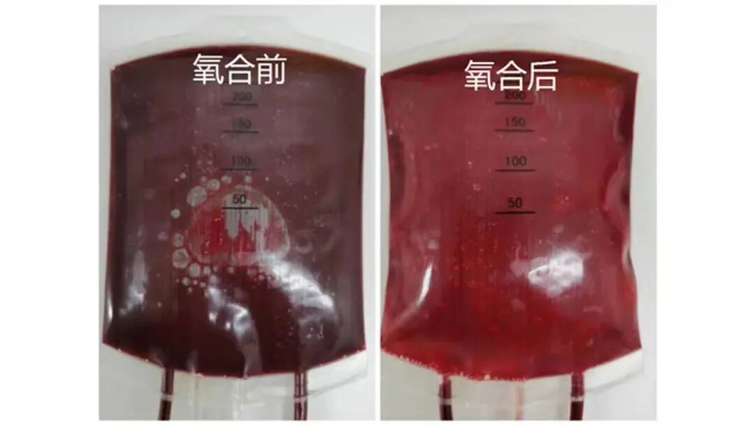 什么是臭氧大自血疗法“自血”治“自病”！阿克苏市人民医院“三氧大自血疗法”了解一下_https://www.jmylbn.com_新闻资讯_第4张