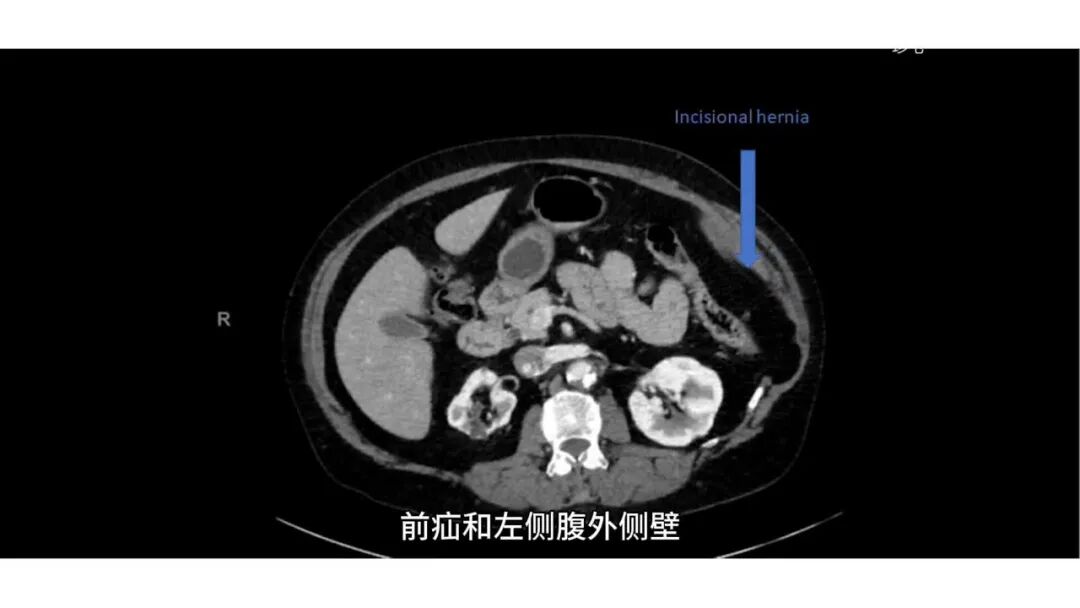 ET在什么手术机器人辅助经腹膜外疝修补术（eTEP）联合单侧经腹膜外疝修补术（eTAR）用于腹壁疝修补，手术技术-上海聚慕医疗器械有限公司