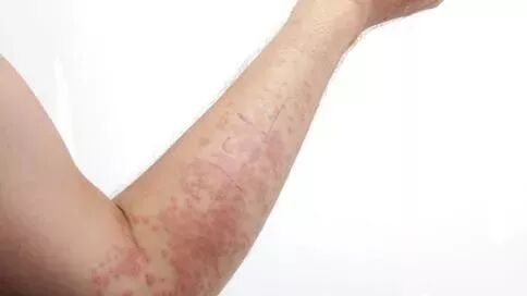 荨麻疹是艾滋病窗口期的症状吗 小娟时间 微信公众号文章阅读 Wemp