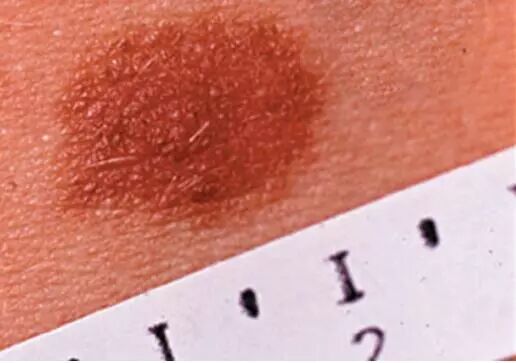 身上有红色的血点鸡皮肤(鸡的身上有出血点是什么病?)