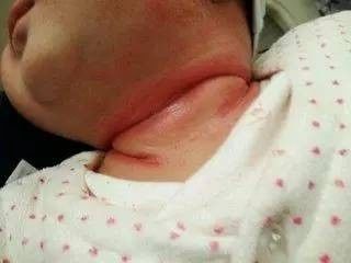 宝宝淹脖子、破皮太遭罪!用这4个方法轻松解决! 宝宝淹脖子、破皮太遭罪!用这4个方法轻松解决!