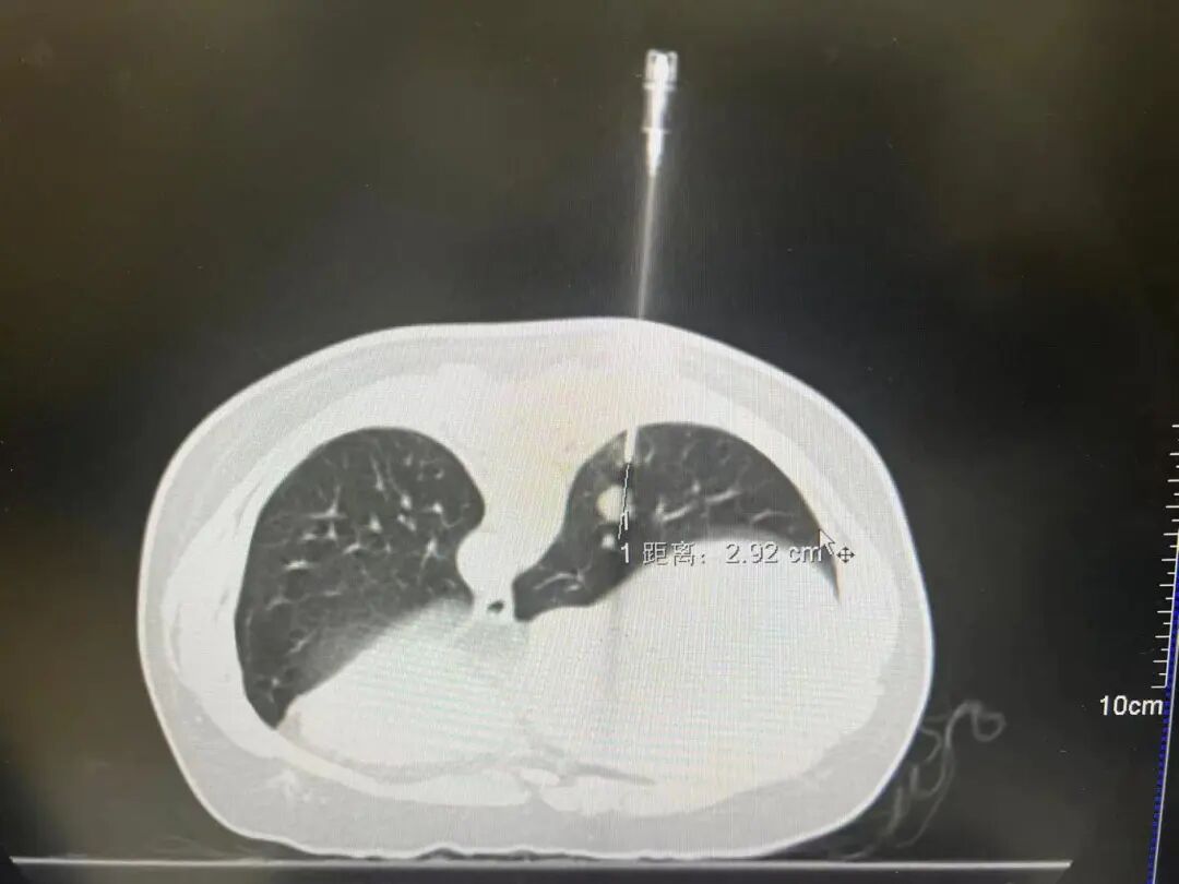 同轴定位针怎么使用一针精准锁定！不骗你，肿瘤活检真是微微痛_https://www.jmylbn.com_新闻资讯_第9张