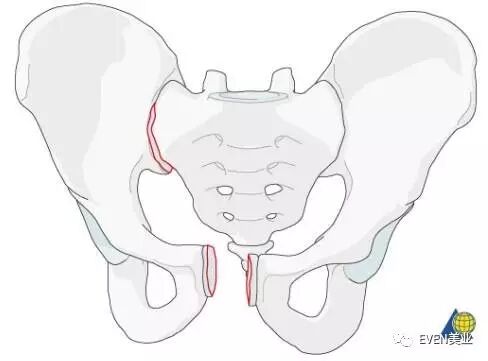 耻骨联合错缝 要人 命 的耻骨痛 艾医学堂 微信公众号文章阅读 Wemp