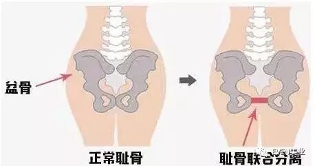 耻骨联合错缝 要人 命 的耻骨痛 手诊识病 微信公众号文章阅读 Wemp