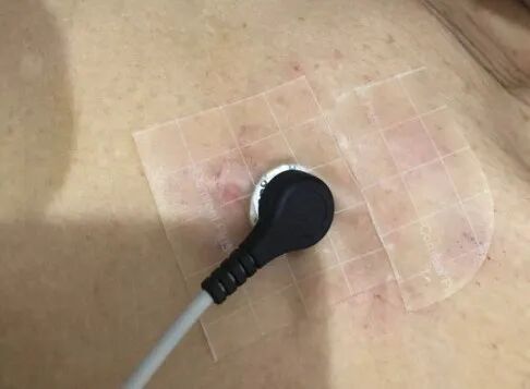 怎么撕敷料啊只需准备一张水胶体敷料，撕电极片不担心皮损了！_https://www.jmylbn.com_新闻资讯_第8张