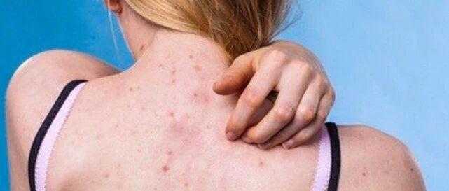 做好这5点，和背上的痘痘轻松说再见