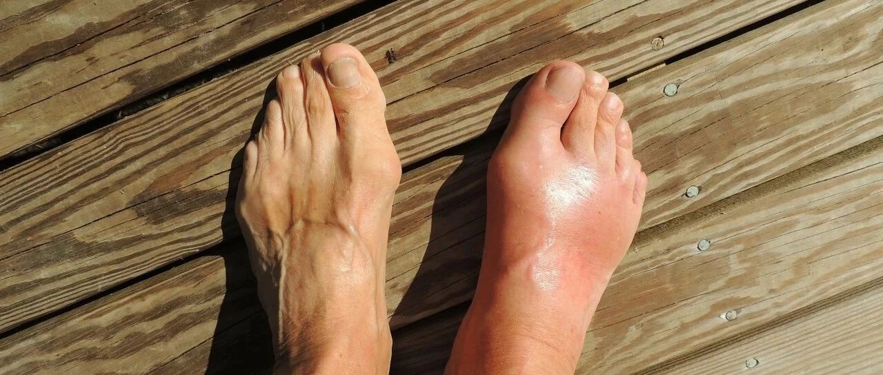 为何那么多年轻的打工人都痛风了？