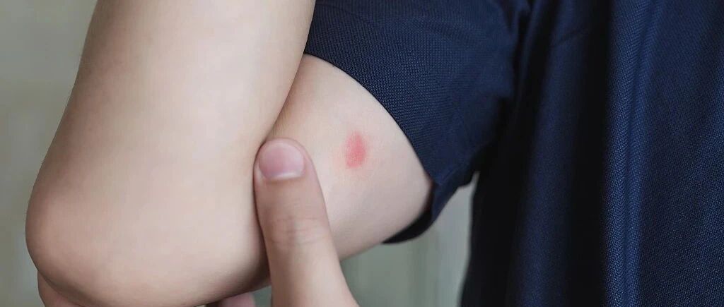 怪不得古人会说“别来无恙”，原来真有恙虫病？