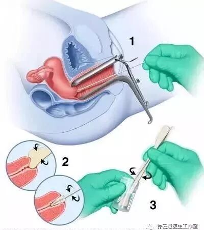 3细胞学检查宫颈癌筛查坚持三阶梯的原则,细胞学或(和)hpv筛查是基础
