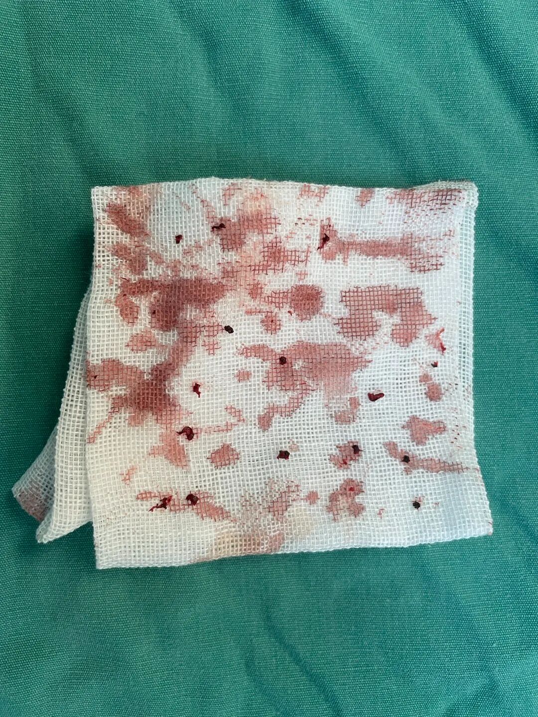 活检钳怎么用医技丨微创引领血管通路新时代，活检钳在自体动静脉内瘘血栓形成中的应用_https://www.jmylbn.com_新闻资讯_第10张