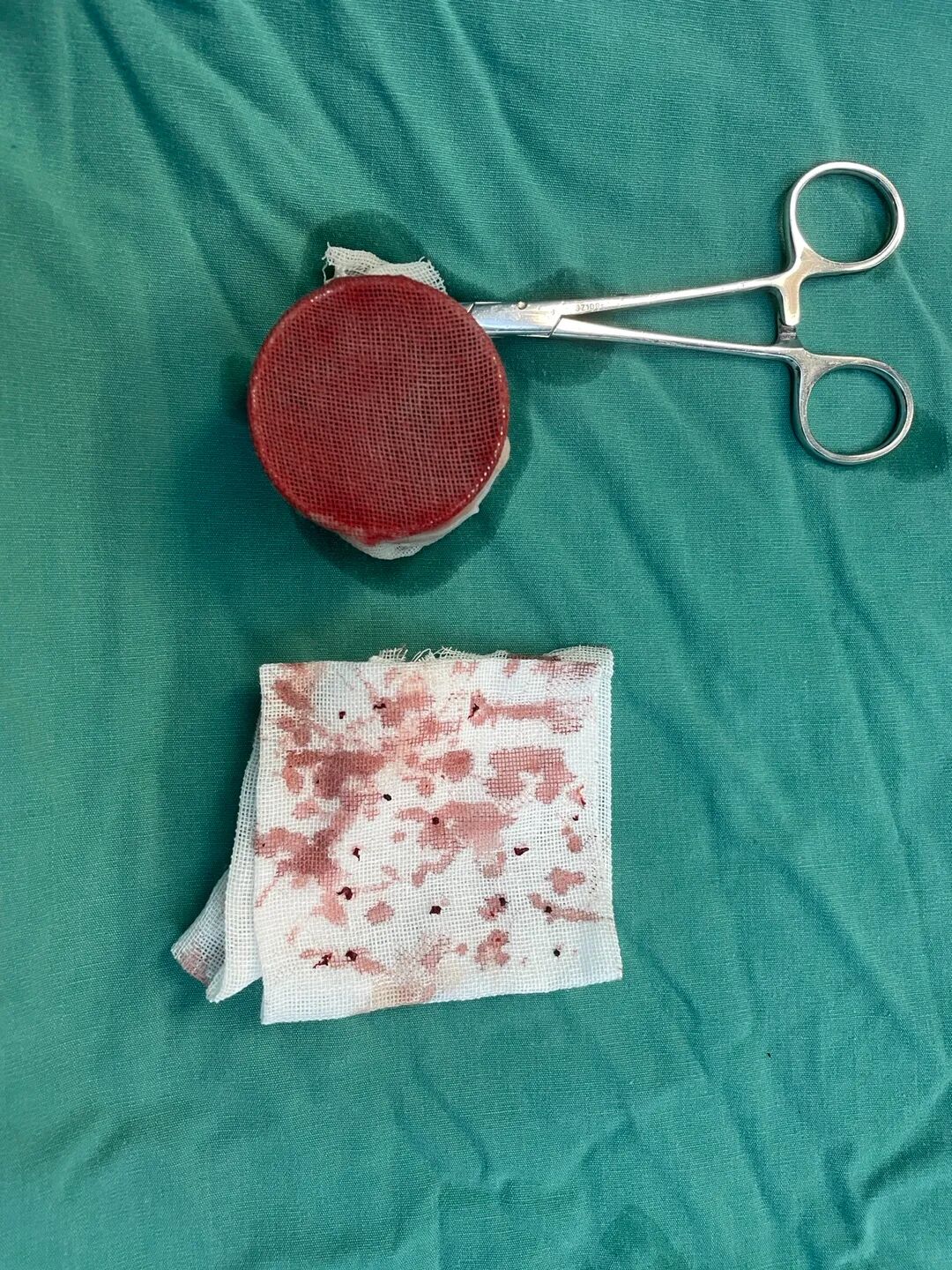 活检钳怎么用医技丨微创引领血管通路新时代，活检钳在自体动静脉内瘘血栓形成中的应用_https://www.jmylbn.com_新闻资讯_第11张