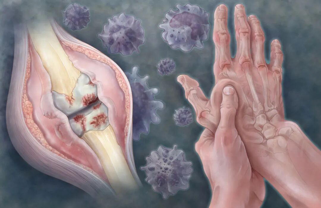 疾病科普｜类风湿性关节炎病因及治疗方法