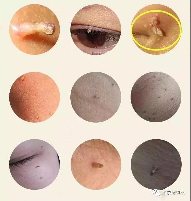 丝状疣最喜欢感染哪些人?