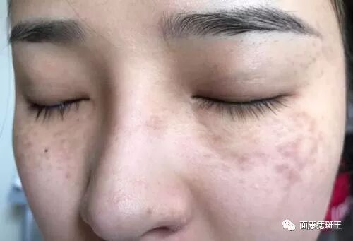 莫把颧部褐青色痣当雀斑