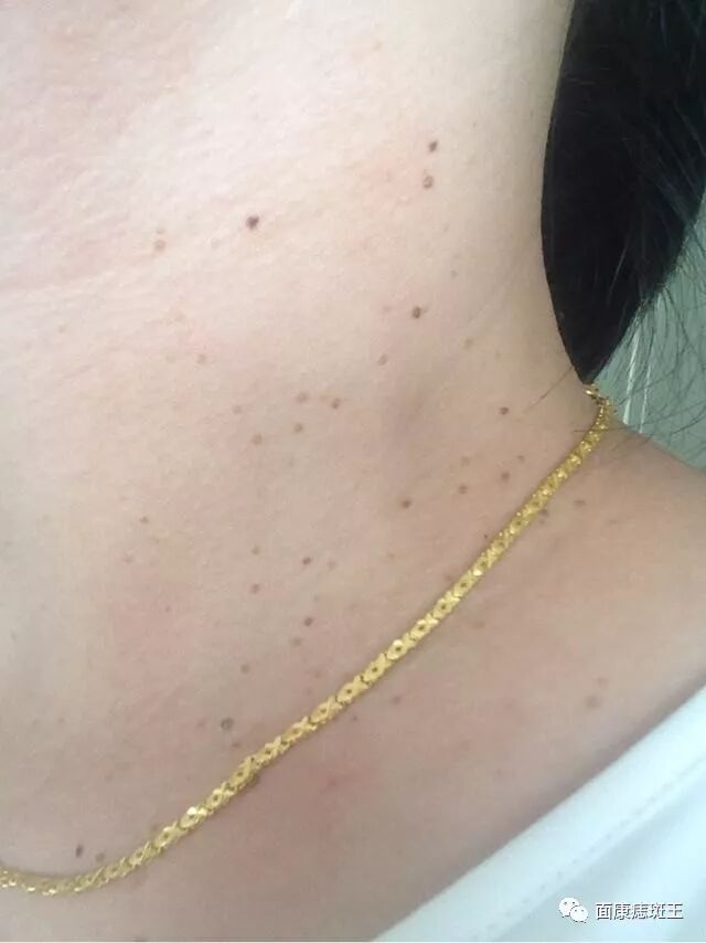 乳头瘤病毒所引起的,发生于皮肤浅表的外形如丝的小赘生物,俗称"线瘊"