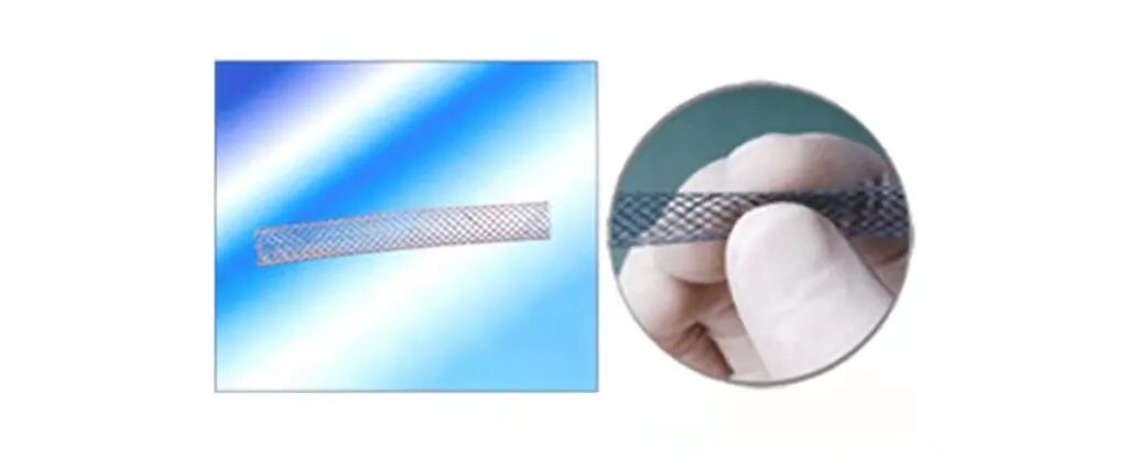 什么是介入耗材原创｜医疗耗材兵器谱之介入支架_https://www.jmylbn.com_新闻资讯_第30张