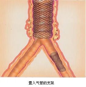 什么是介入耗材原创｜医疗耗材兵器谱之介入支架_https://www.jmylbn.com_新闻资讯_第29张