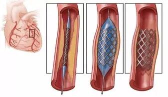 什么是介入耗材原创｜医疗耗材兵器谱之介入支架_https://www.jmylbn.com_新闻资讯_第27张