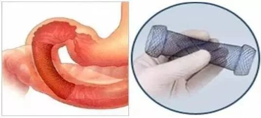 什么是介入耗材原创｜医疗耗材兵器谱之介入支架_https://www.jmylbn.com_新闻资讯_第28张