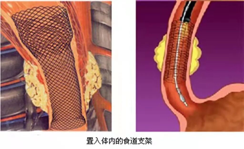 什么是介入耗材原创｜医疗耗材兵器谱之介入支架_https://www.jmylbn.com_新闻资讯_第31张