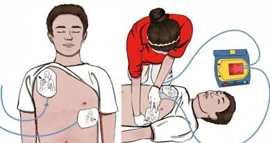 aed电极贴怎么贴AED学习指南_https://www.jmylbn.com_新闻资讯_第19张