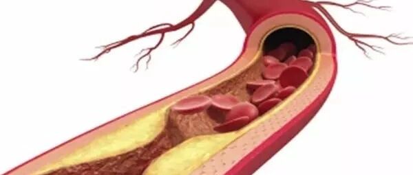 8张动图揭秘血管堵的全过程！建议每个人都该看看