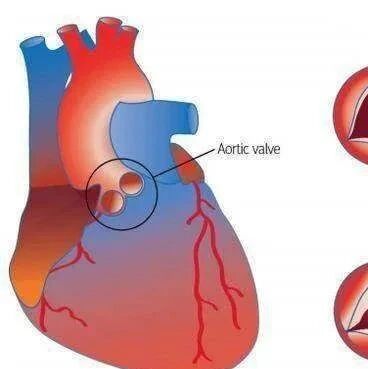 什么是心脏瓣膜病？晚期心脏瓣膜病患者是不是只能做手术？