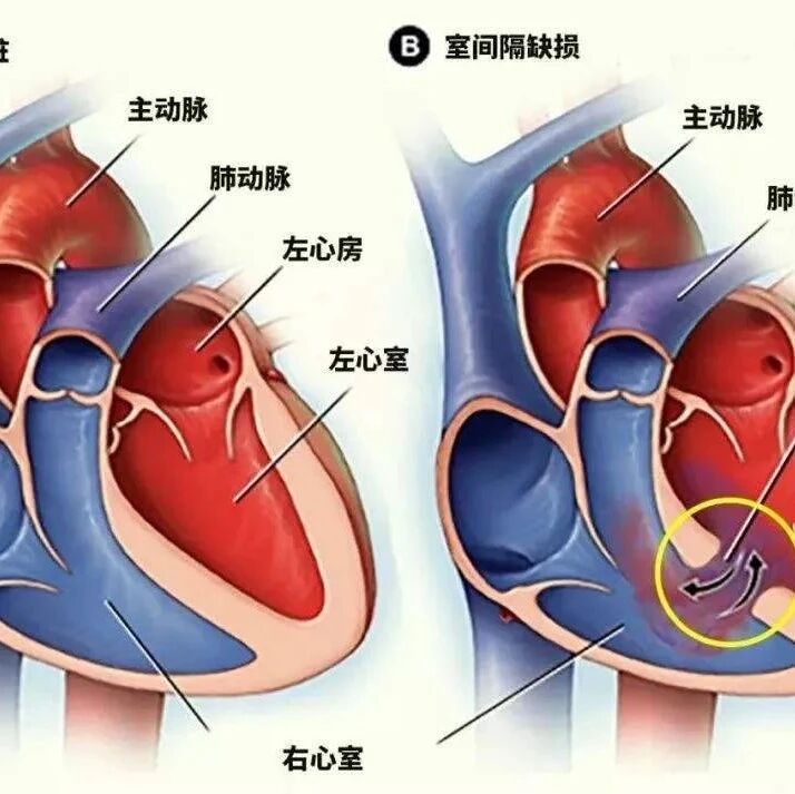什么是先天性心脏病室间隔缺损？