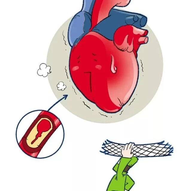 冠心病术后莫随意停药