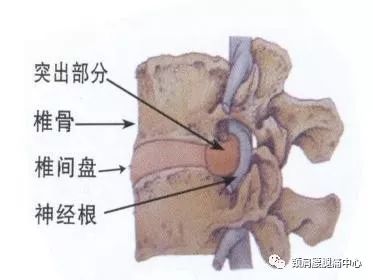 腰椎间盘突出症 症状侧与突出侧不符怎么办 颈肩腰腿痛中心 微信公众号文章阅读 Wemp