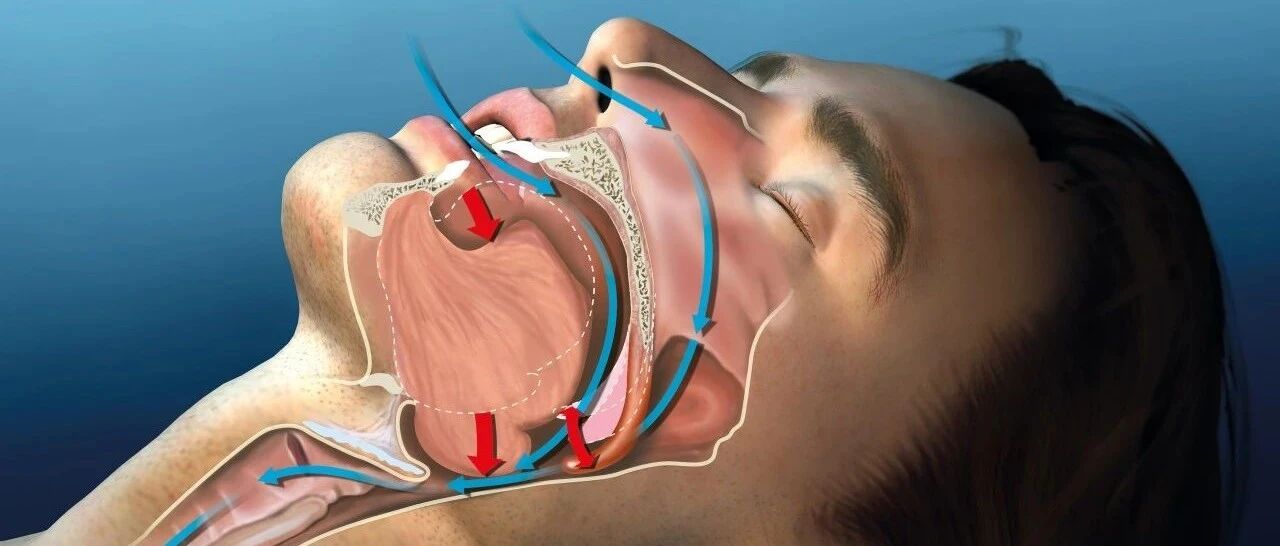 打着呼噜，他就走了！有这些症状的人一定要看看!