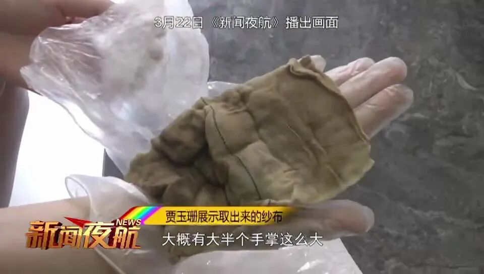 纱块怎么利用哈尔滨女子产后腹痛！竟拽出一块纱布！已发黑……_https://www.jmylbn.com_新闻资讯_第2张