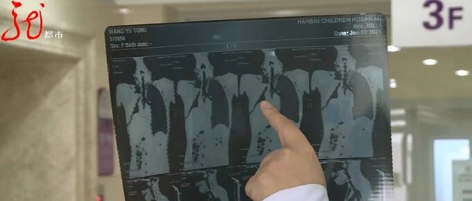 黑龙江9岁孩子炕头摔一跤，气管竟然爆裂断成渣，右侧肺缩成了一个球