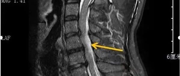 男子肩颈疼痛，2小时后全身失去知觉！医生：严重可瞬间致命！