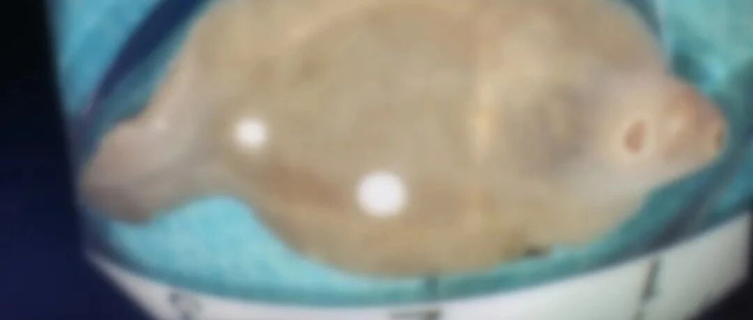 女子肝脏被吃掉三分之一！“凶手”找到！竟是体内这条“鱼”！