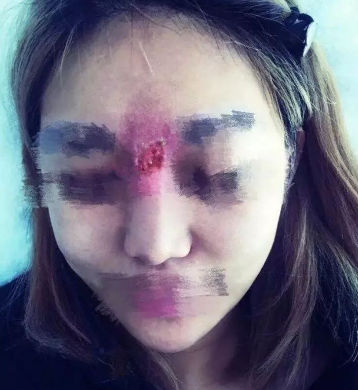 中國女人熱捧的瘦臉針到底多神奇？BBC揭殘酷真相