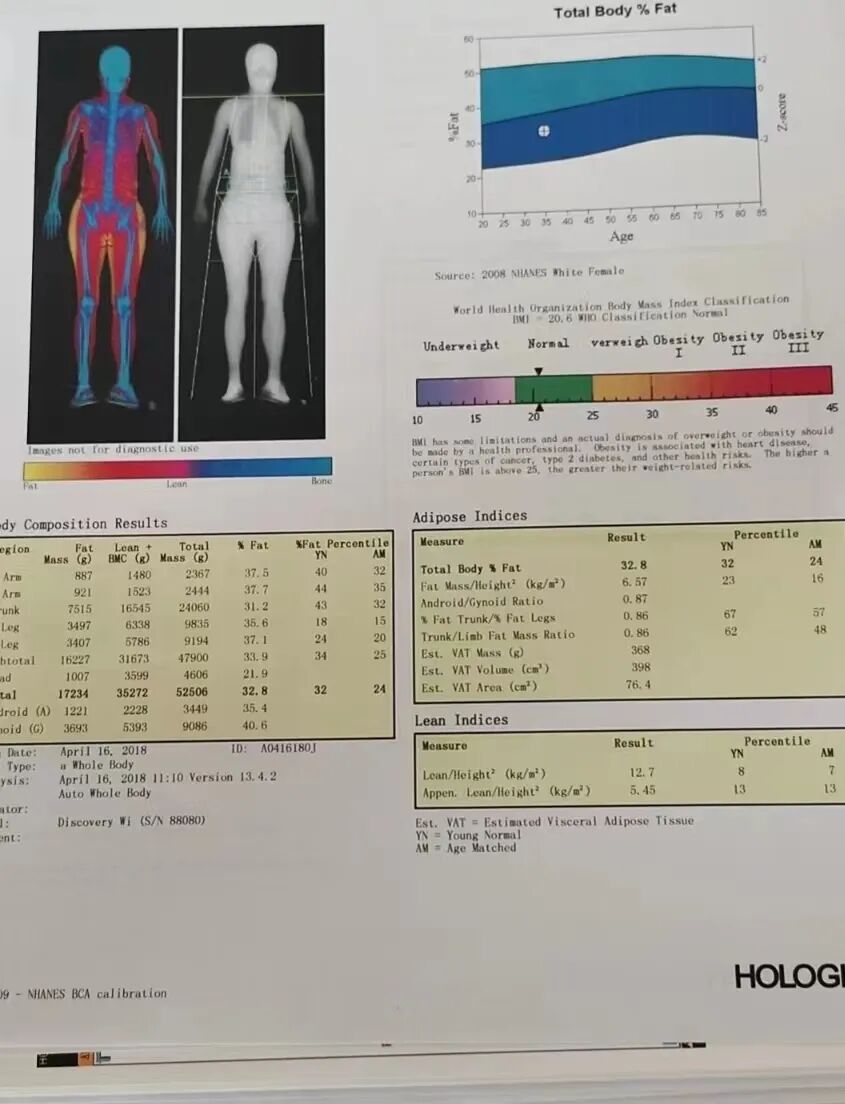 骨密度影是什么甲状腺癌全身多发转移病例（肺 骨 脑）_https://www.jmylbn.com_新闻资讯_第6张