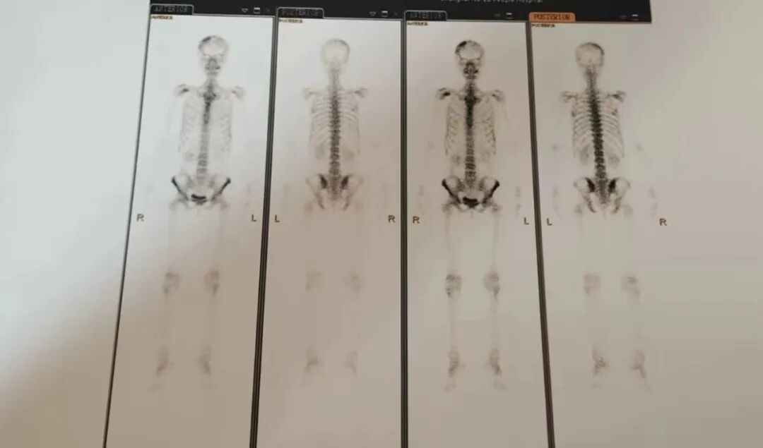 骨密度影是什么甲状腺癌全身多发转移病例（肺 骨 脑）_https://www.jmylbn.com_新闻资讯_第10张