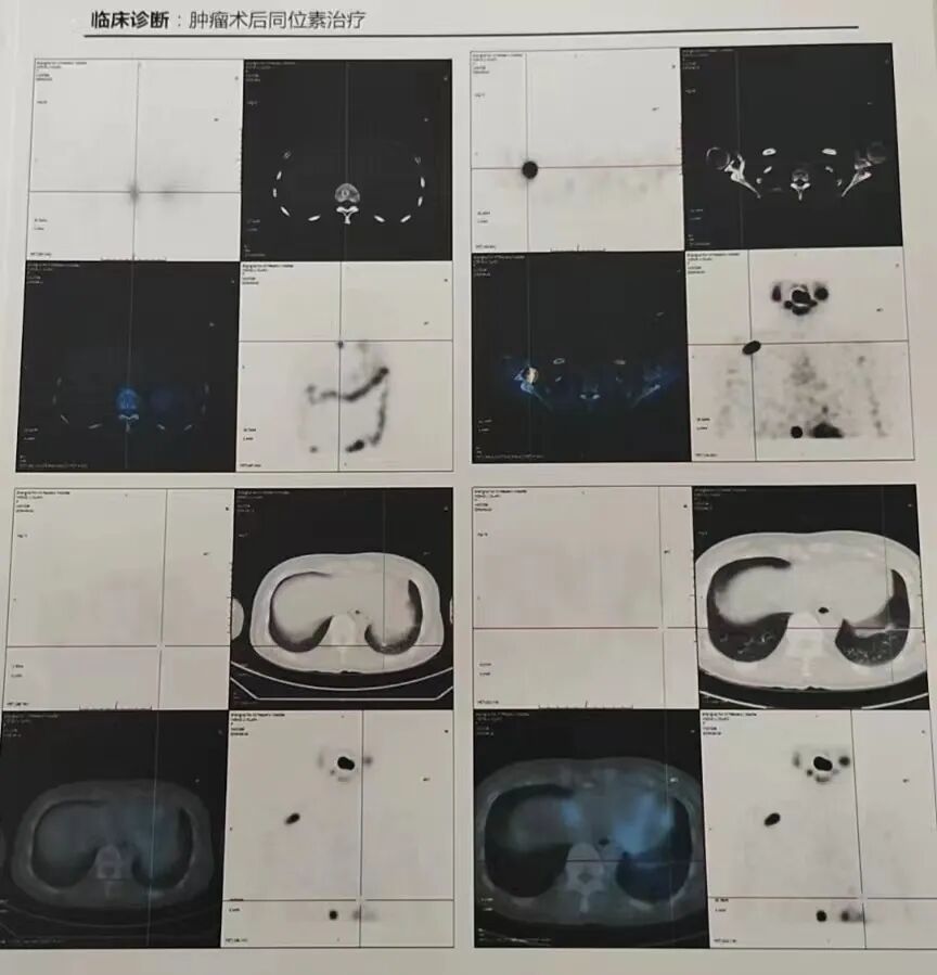 骨密度影是什么甲状腺癌全身多发转移病例（肺 骨 脑）_https://www.jmylbn.com_新闻资讯_第8张