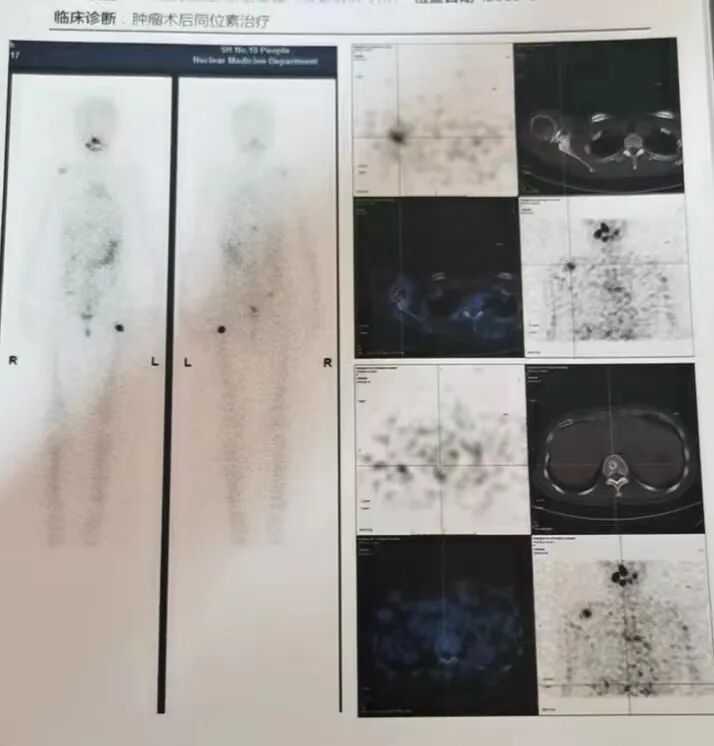 骨密度影是什么甲状腺癌全身多发转移病例（肺 骨 脑）_https://www.jmylbn.com_新闻资讯_第14张