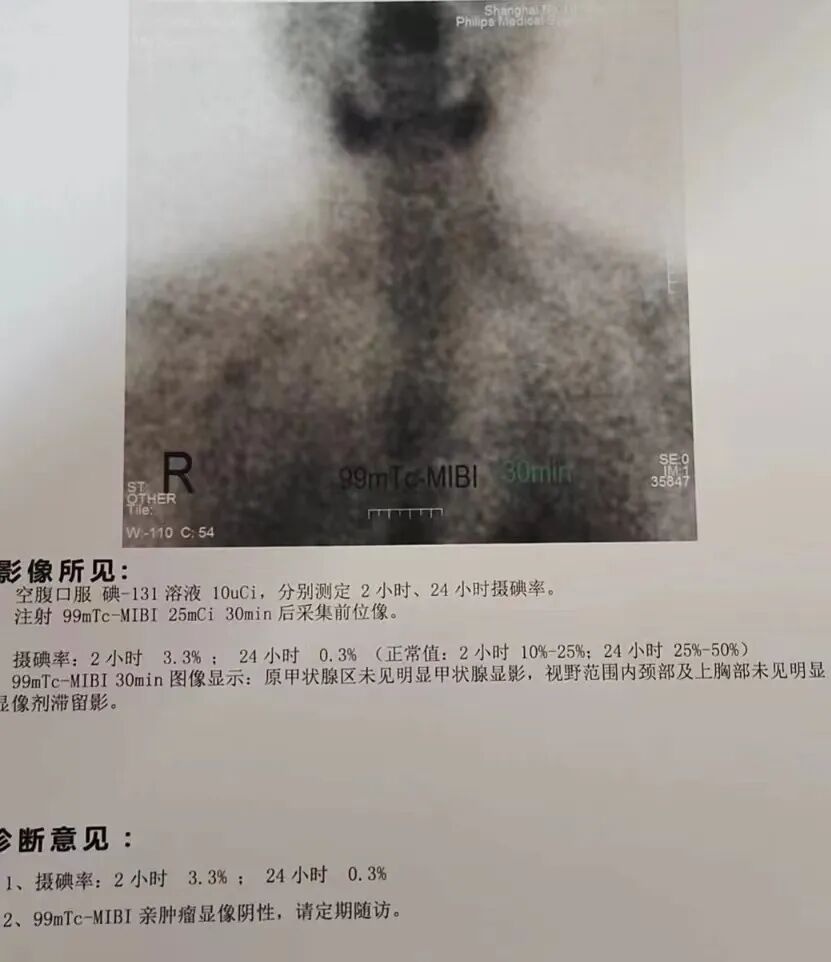 骨密度影是什么甲状腺癌全身多发转移病例（肺 骨 脑）_https://www.jmylbn.com_新闻资讯_第13张