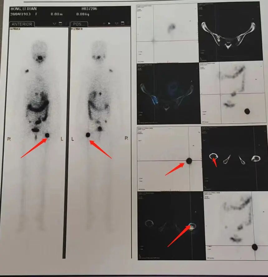骨密度影是什么甲状腺癌全身多发转移病例（肺 骨 脑）_https://www.jmylbn.com_新闻资讯_第12张