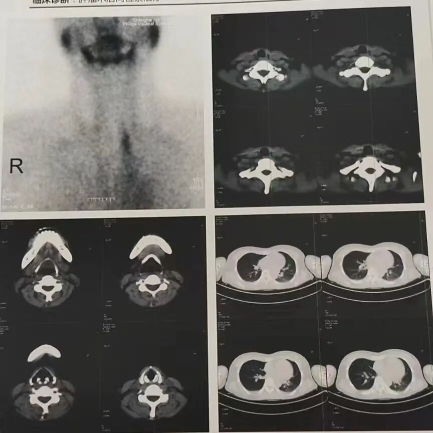 骨密度影是什么甲状腺癌全身多发转移病例（肺 骨 脑）_https://www.jmylbn.com_新闻资讯_第9张