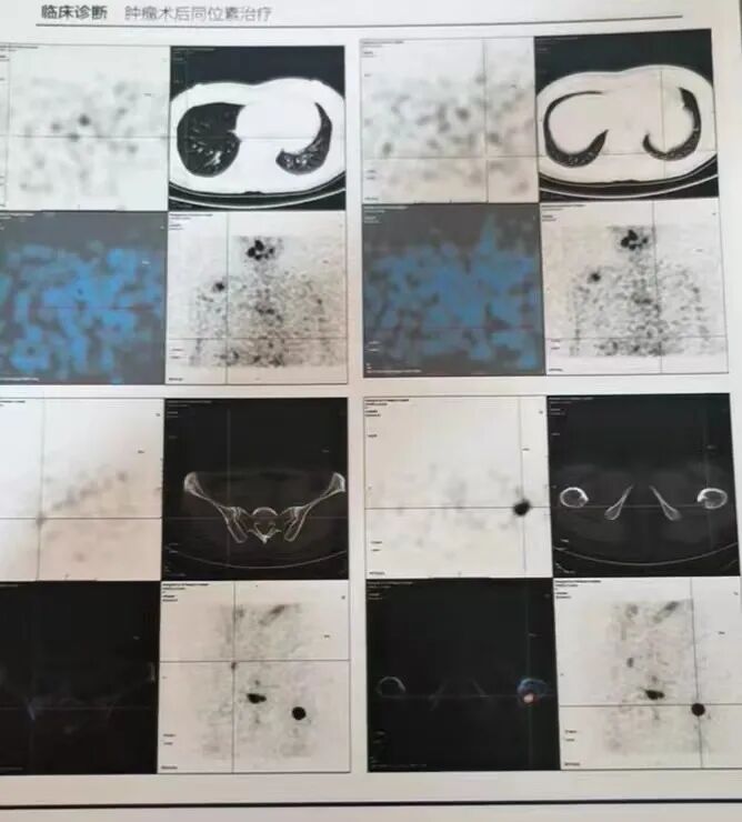 骨密度影是什么甲状腺癌全身多发转移病例（肺 骨 脑）_https://www.jmylbn.com_新闻资讯_第15张